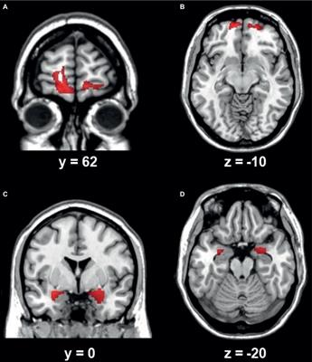 Structural and Functional Connectivity Between the Amygdala and Orbital Frontal Cortex in Burning Mouth Syndrome: An fMRI Study